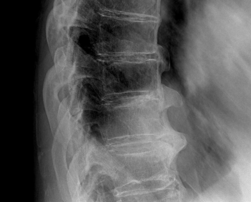 DISH Thoracic Vertebra Lateral